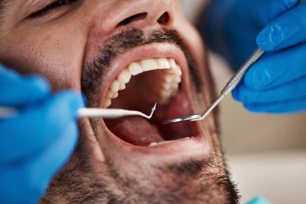 Best Emergency Tooth Extraction in Frazer, PA