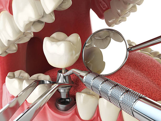 Best Emergency Tooth Extraction in Frazer, PA